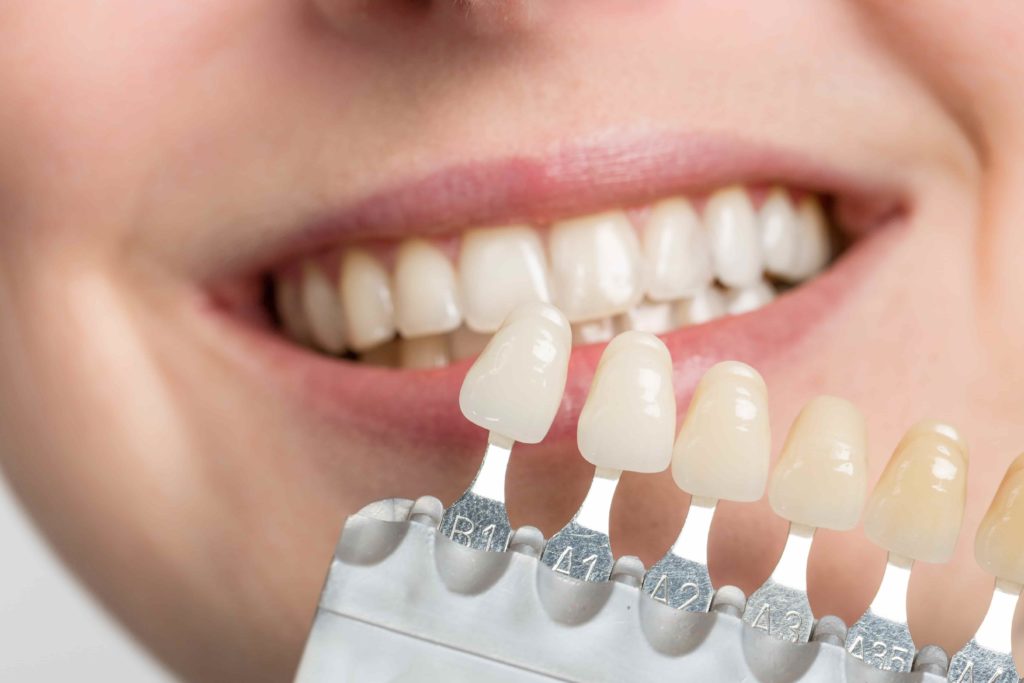 Understanding the Differences between Veneers and Crowns for a Better Smile