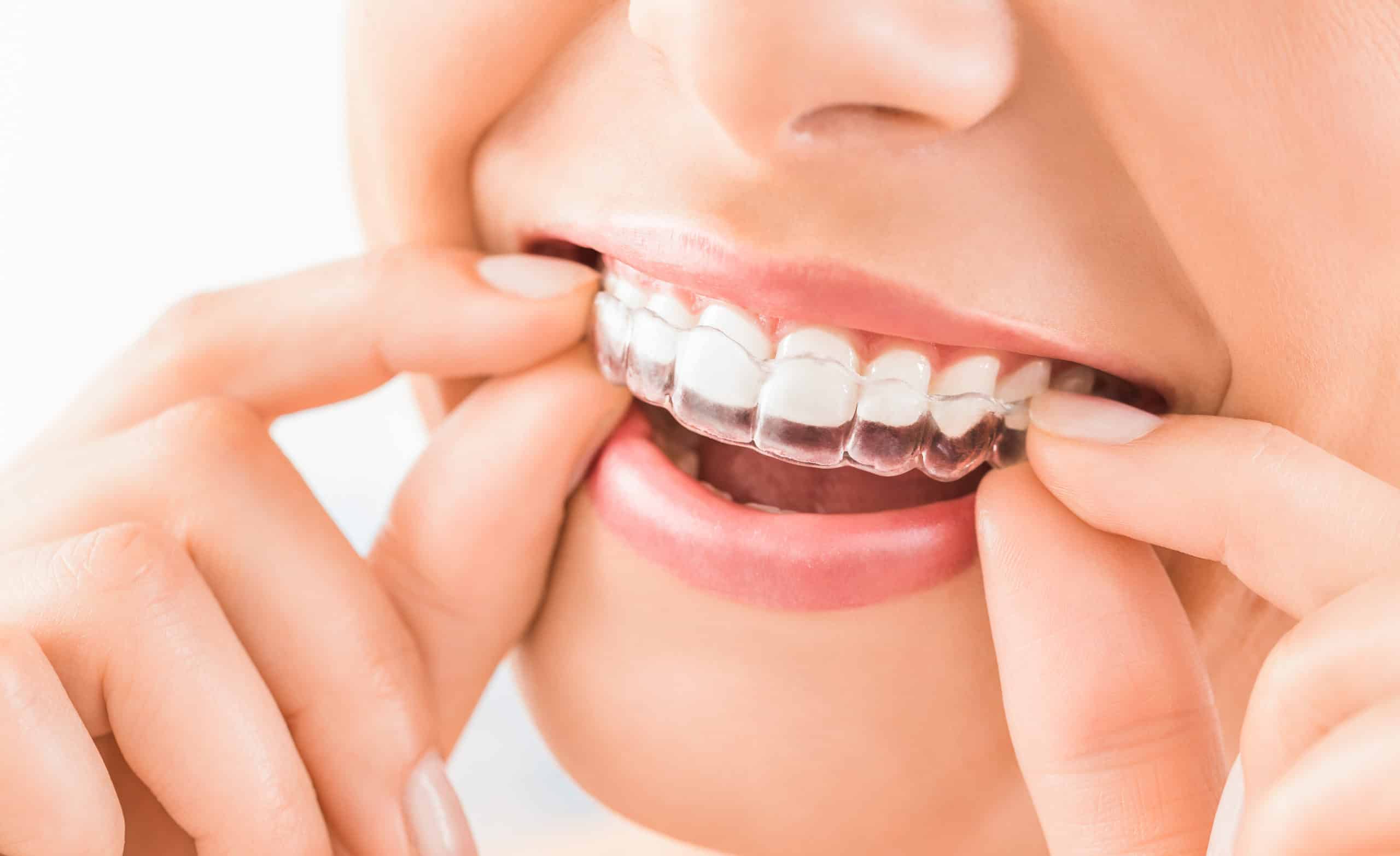The Ultimate Guide to Invisalign Everything You Need to Know